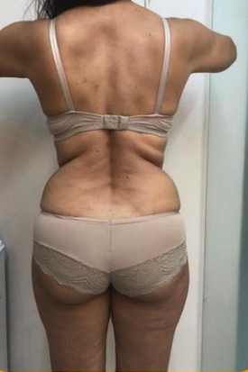 Resultado após harmonização corporal