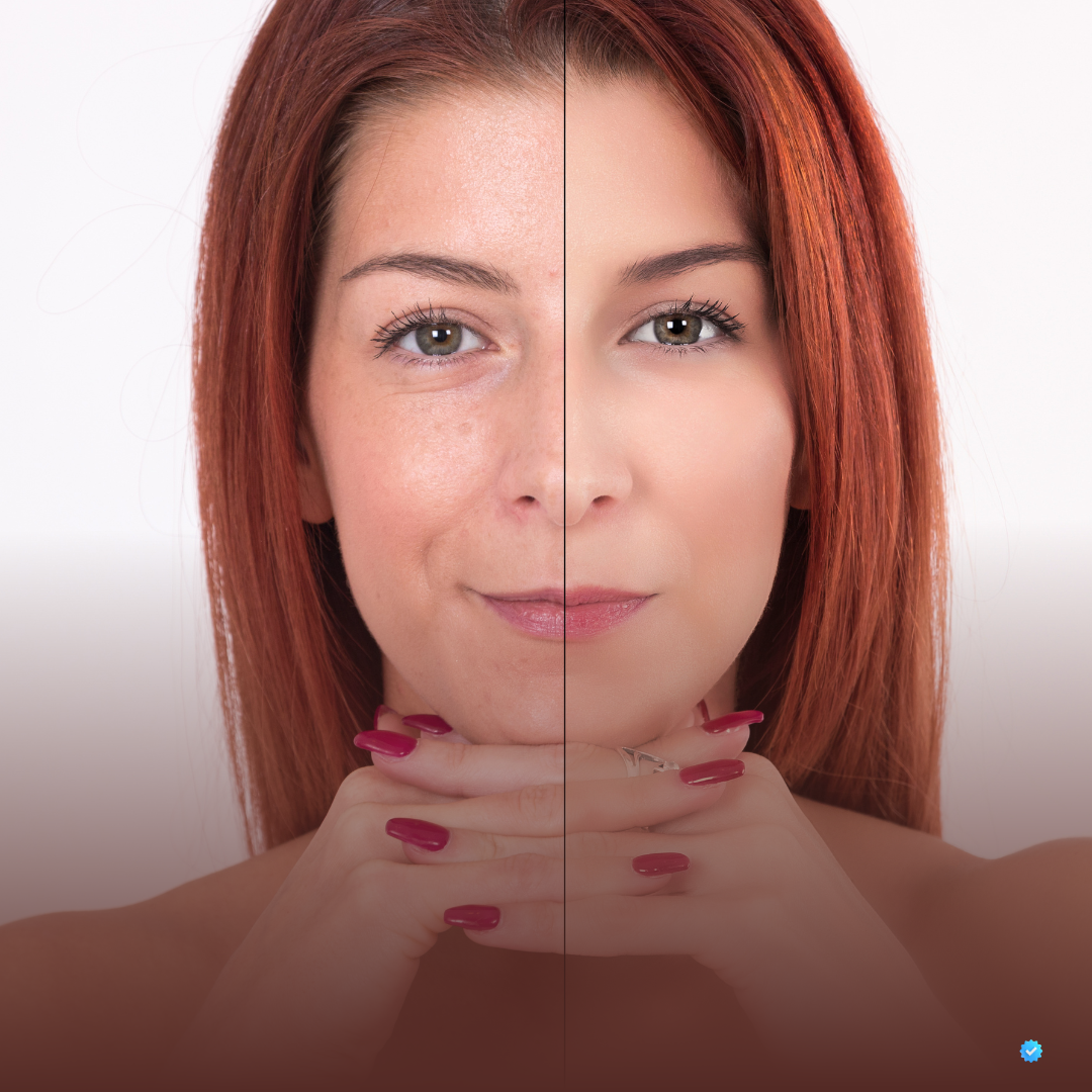 Procedimento com bioestimulador