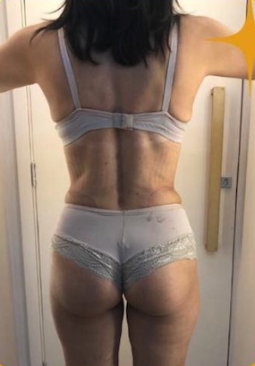 Comparação de antes e depois em harmonização corporal