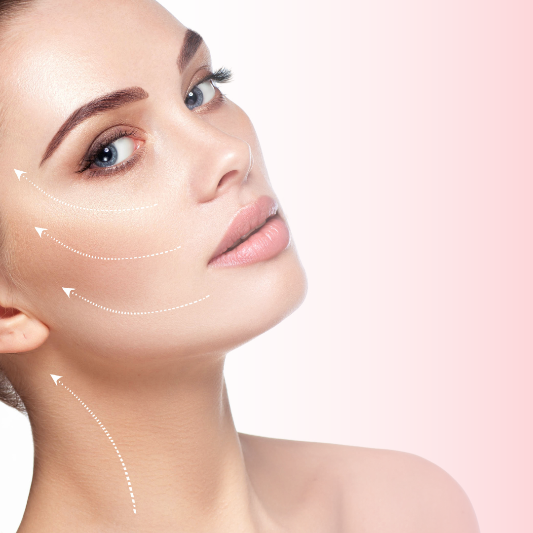 Procedimento com fios de PDO