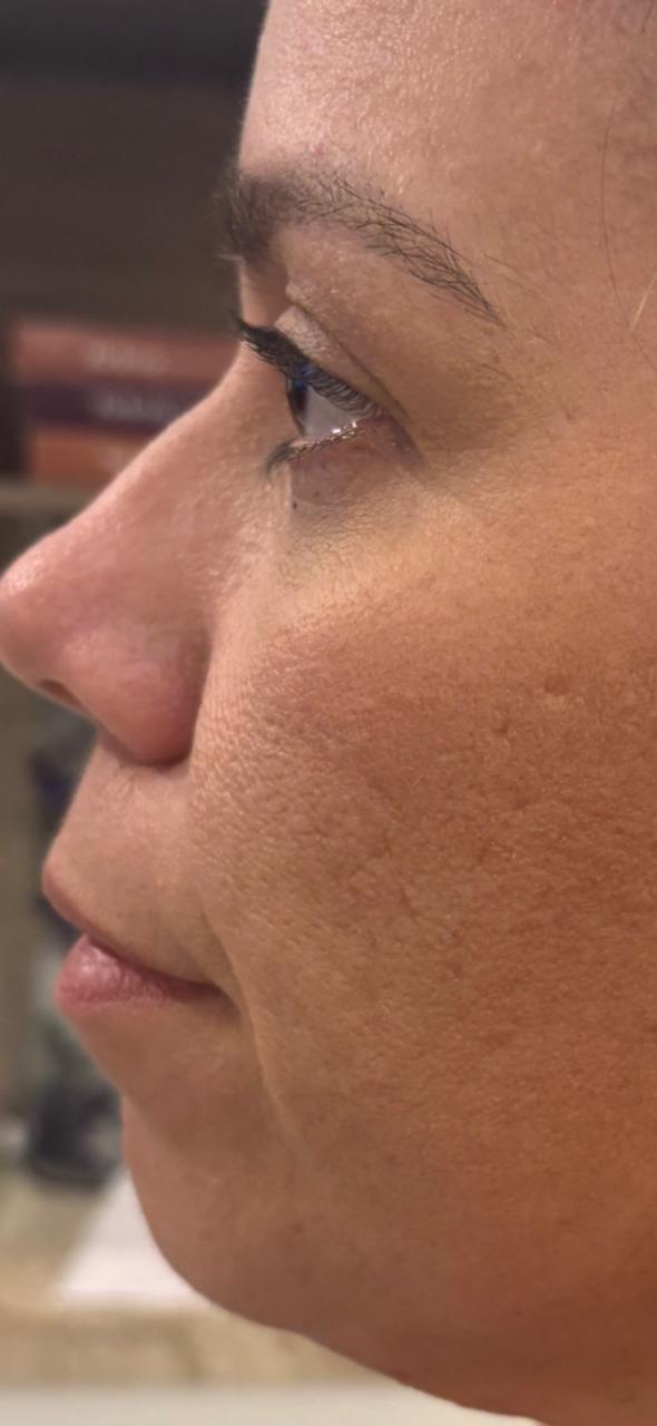 Resultado após bioestimulação