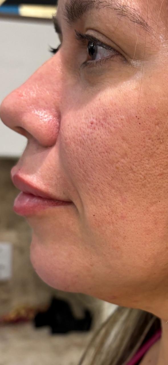 Comparação de antes e depois em bioestimulação