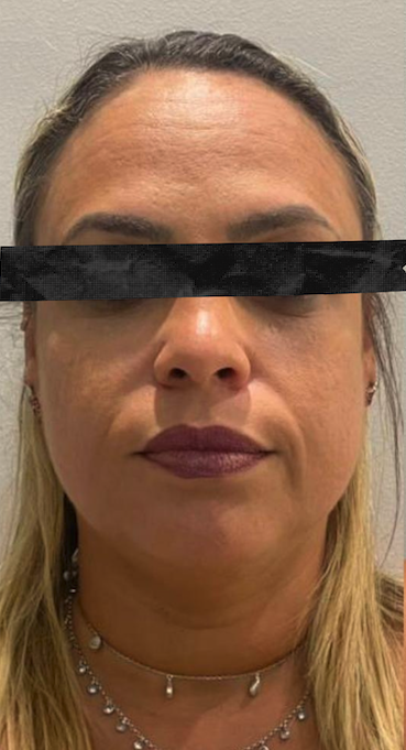 Resultado após harmonização facial