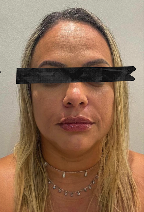 Comparação de antes e depois em harmonização facial